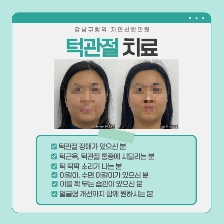 턱관절 치료 사례 — 시술 전과 4회차 비교