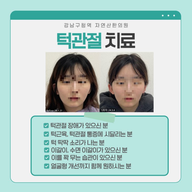 턱관절 치료 사례 — 시술 전과 5회차 비교