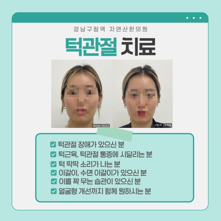 턱관절 치료 사례 — 시술 전과 2회차 비교