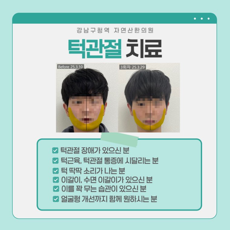 턱관절 치료 사례 — 시술 전과 3회차 비교, 하관 라인 표시