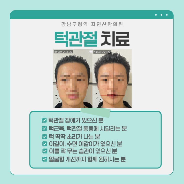 턱관절 치료 사례 — 시술 전과 1회차 비교, 좌우 기준선 표시