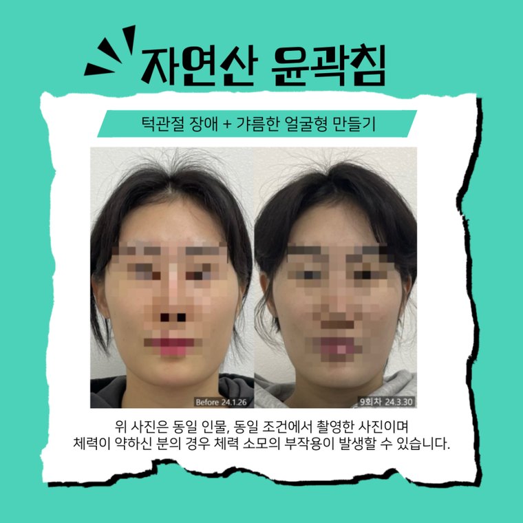 tmj-disorder-clinic 치료 사례 1 — 시술 전후 비교
