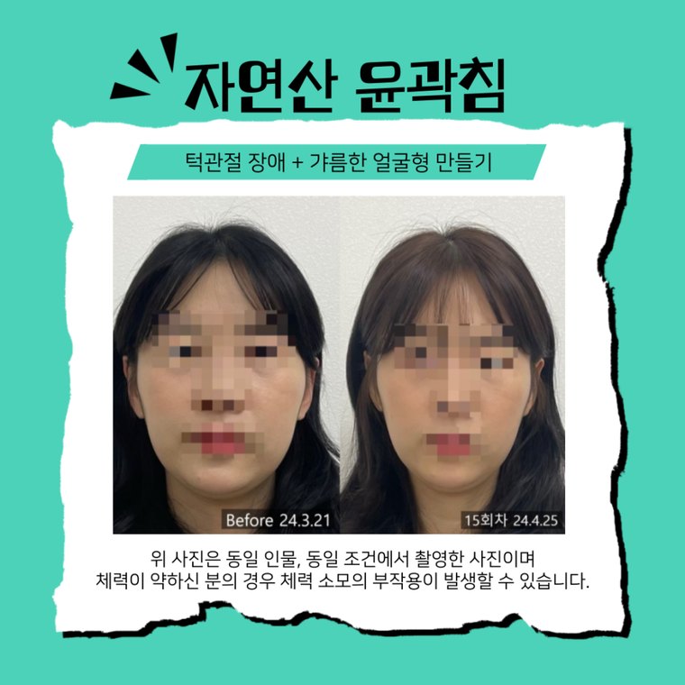 tmj-disorder-clinic 치료 사례 2 — 시술 전후 비교