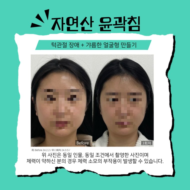 tmj-disorder-clinic 치료 사례 3 — 시술 전후 비교