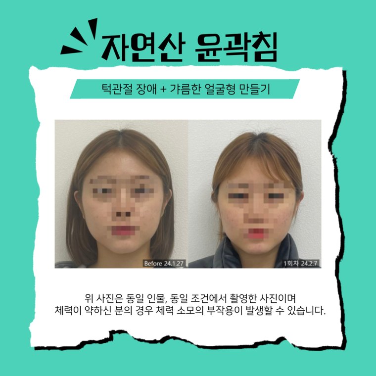 tmj-disorder-clinic 치료 사례 4 — 시술 전후 비교
