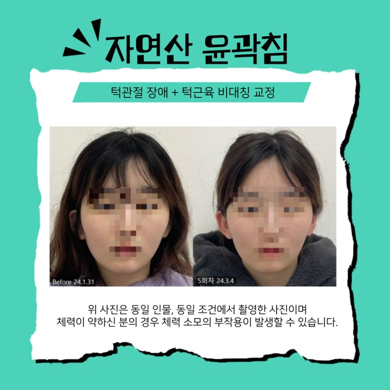 tmj-disorder-clinic 치료 사례 5 — 시술 전후 비교