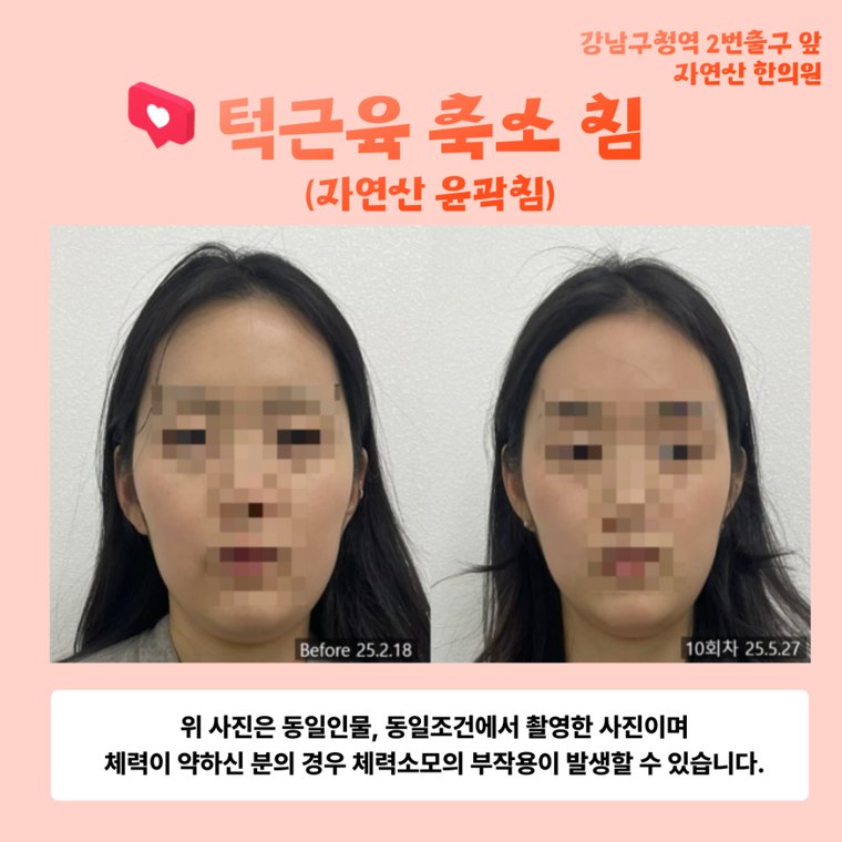 tmj-disorder-correction 치료 사례 1 — 시술 전후 비교