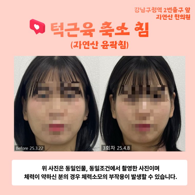 tmj-disorder-correction 치료 사례 2 — 시술 전후 비교