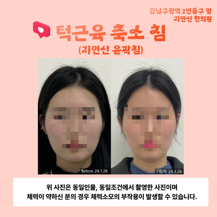 tmj-disorder-correction 치료 사례 3 — 시술 전후 비교