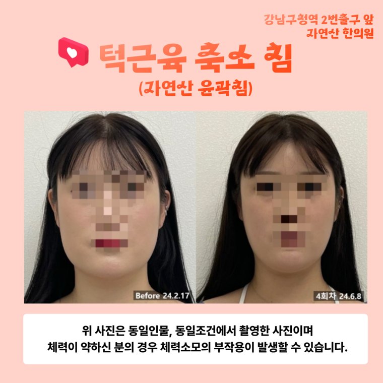 tmj-disorder-correction 치료 사례 4 — 시술 전후 비교