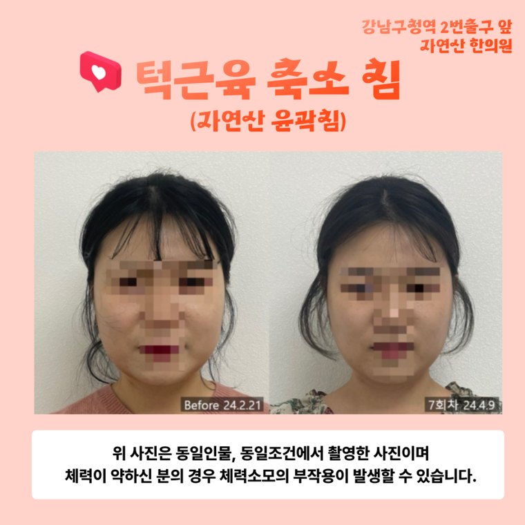 tmj-disorder-correction 치료 사례 5 — 시술 전후 비교