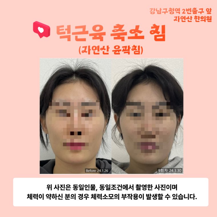 tmj-disorder-correction 치료 사례 6 — 시술 전후 비교