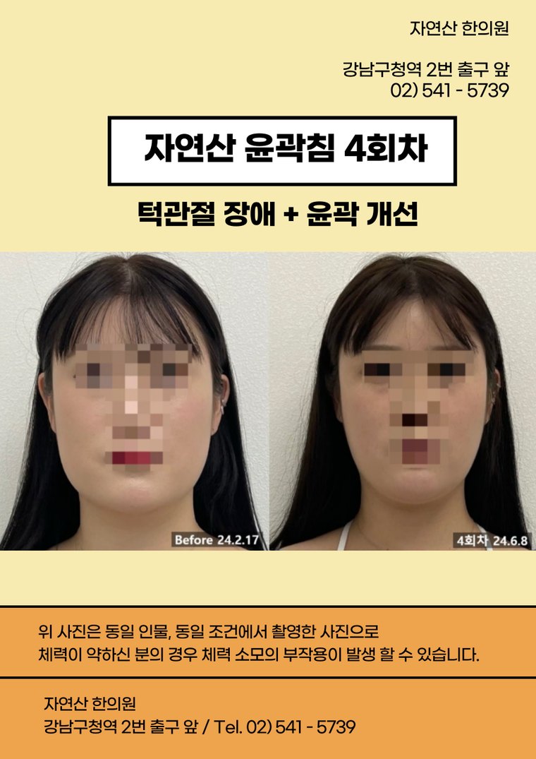 tmj-disorder-treatment 치료 사례 1 — 시술 전후 비교