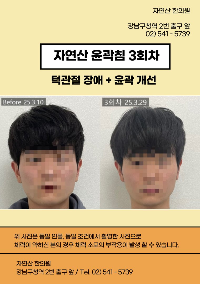 tmj-disorder-treatment 치료 사례 3 — 시술 전후 비교