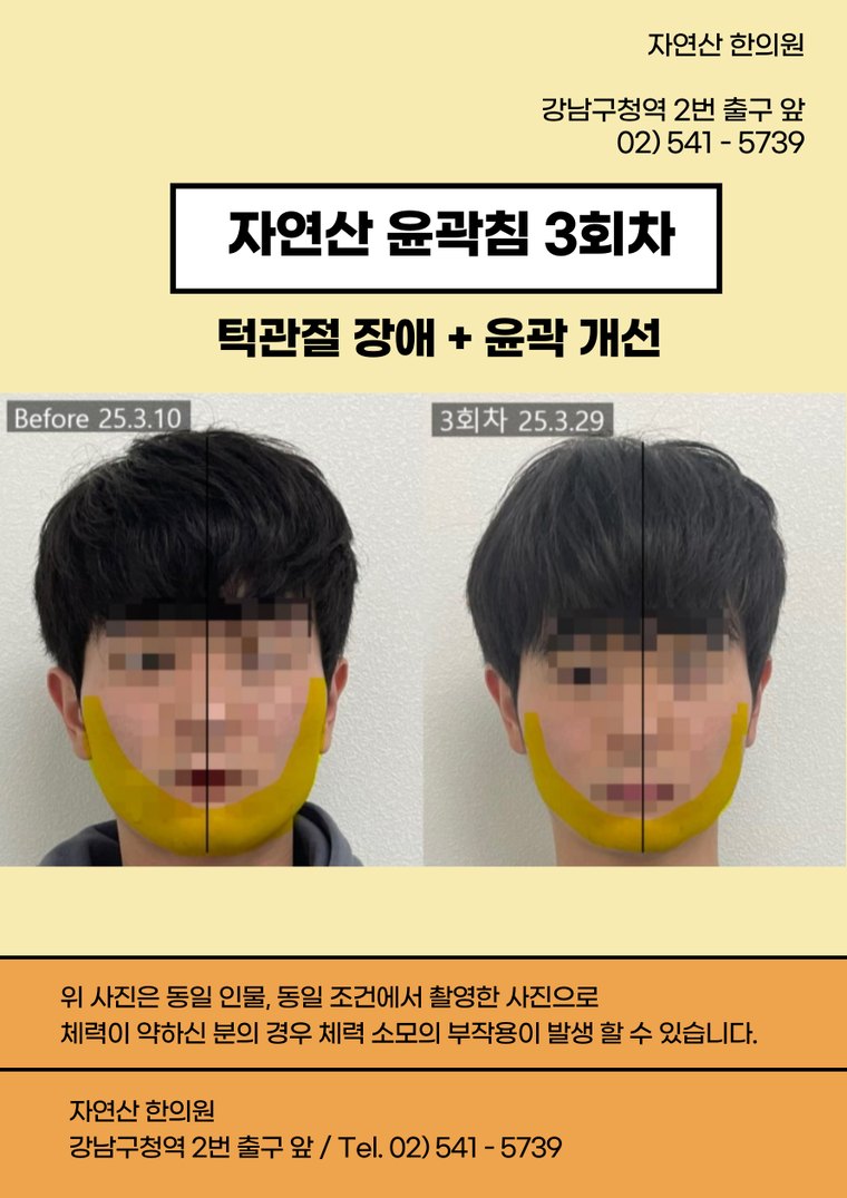 tmj-disorder-treatment 치료 사례 4 — 시술 전후 비교