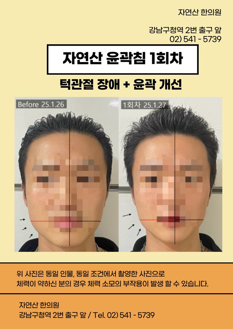 tmj-disorder-treatment 치료 사례 5 — 시술 전후 비교
