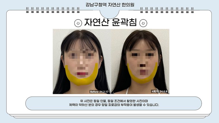 tmj-pain 치료 사례 1 — 시술 전후 비교