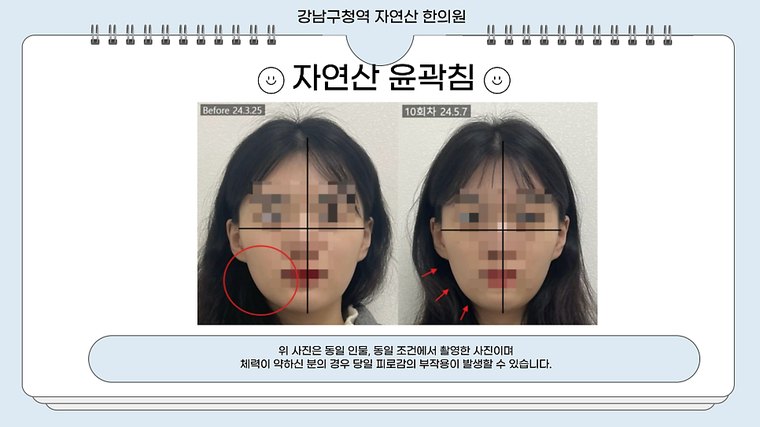 tmj-pain 치료 사례 2 — 시술 전후 비교