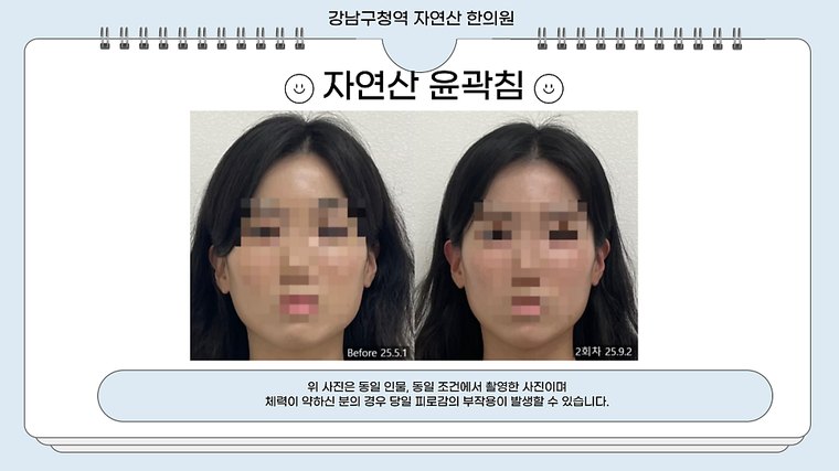 tmj-pain 치료 사례 3 — 시술 전후 비교