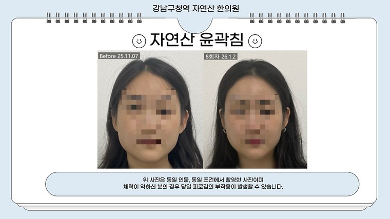 tmj-pain 치료 사례 4 — 시술 전후 비교