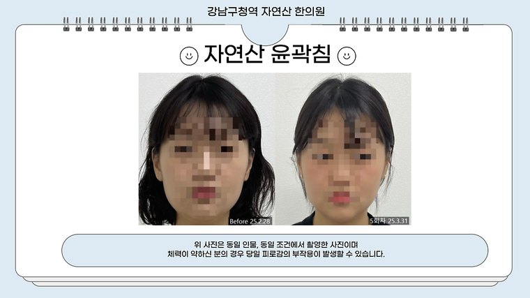 tmj-pain 치료 사례 5 — 시술 전후 비교