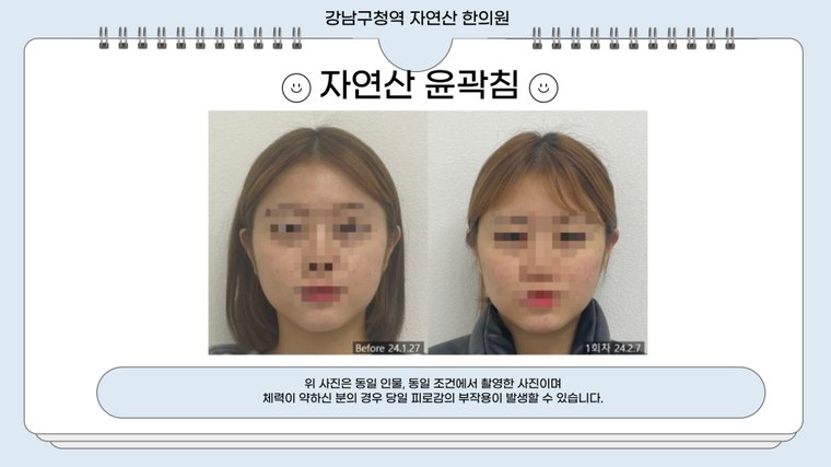 tmj-pain 치료 사례 6 — 시술 전후 비교