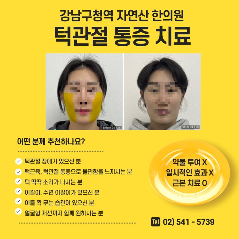 tmj-pain-treatment 치료 사례 1 — 시술 전후 비교