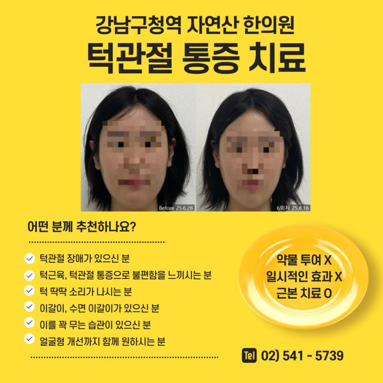 tmj-pain-treatment 치료 사례 2 — 시술 전후 비교