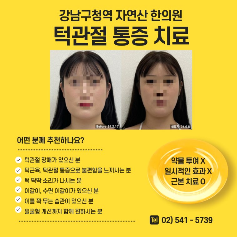 tmj-pain-treatment 치료 사례 3 — 시술 전후 비교