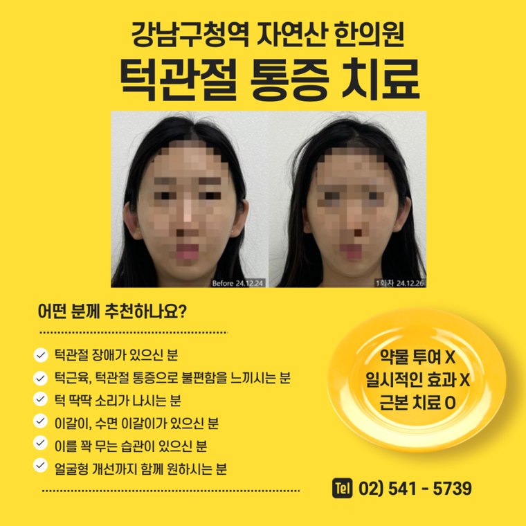 tmj-pain-treatment 치료 사례 4 — 시술 전후 비교
