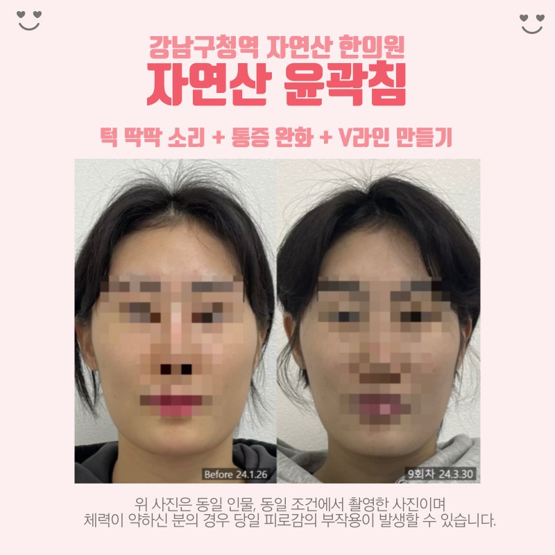 자연산 윤곽침 9회차 정면 전후 비교 — 동일 인물·동일 조건에서 촬영한 보정 없는 원본