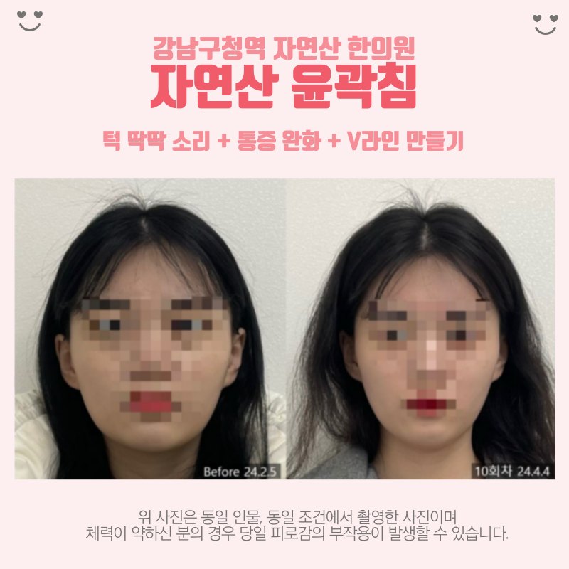 다른 분의 10회차 정면 전후 비교 — 동일 인물·동일 조건에서 촬영한 보정 없는 원본