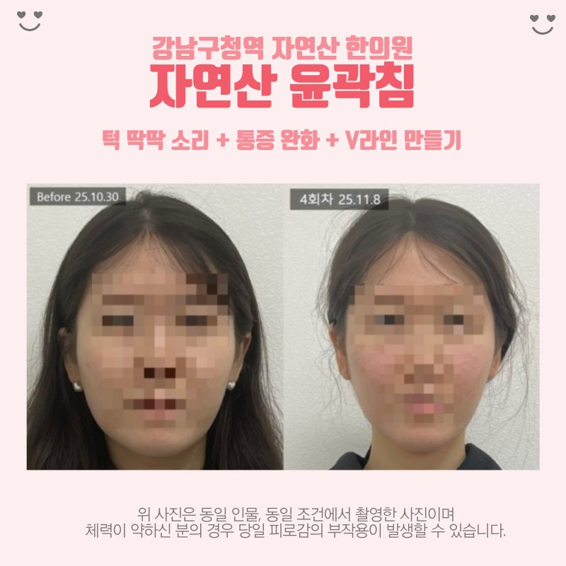 가장 짧은 기간에 촬영한 4회차 정면 전후 비교 — 보정 없는 원본