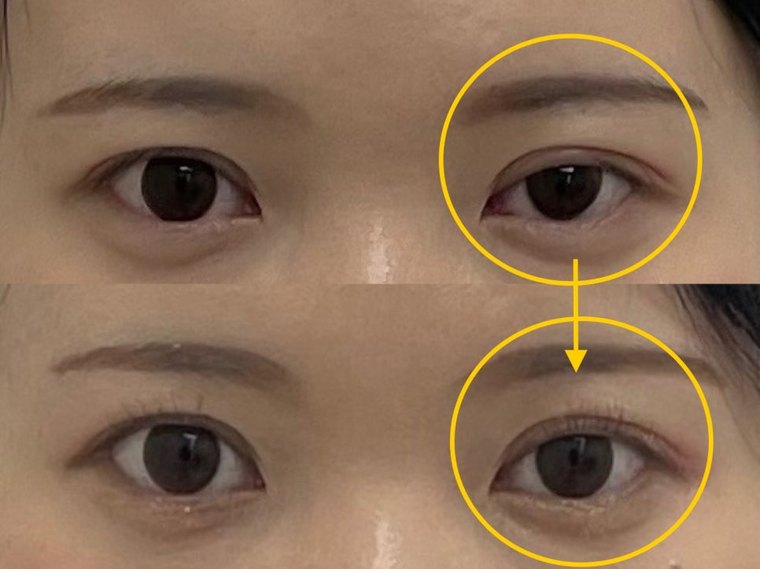 uneven-eyes-correction 치료 사례 1 — 시술 전후 비교