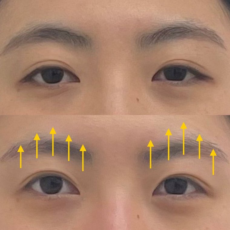 uneven-eyes-correction 치료 사례 2 — 시술 전후 비교