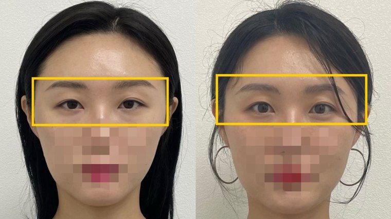 uneven-eyes-correction 치료 사례 3 — 시술 전후 비교