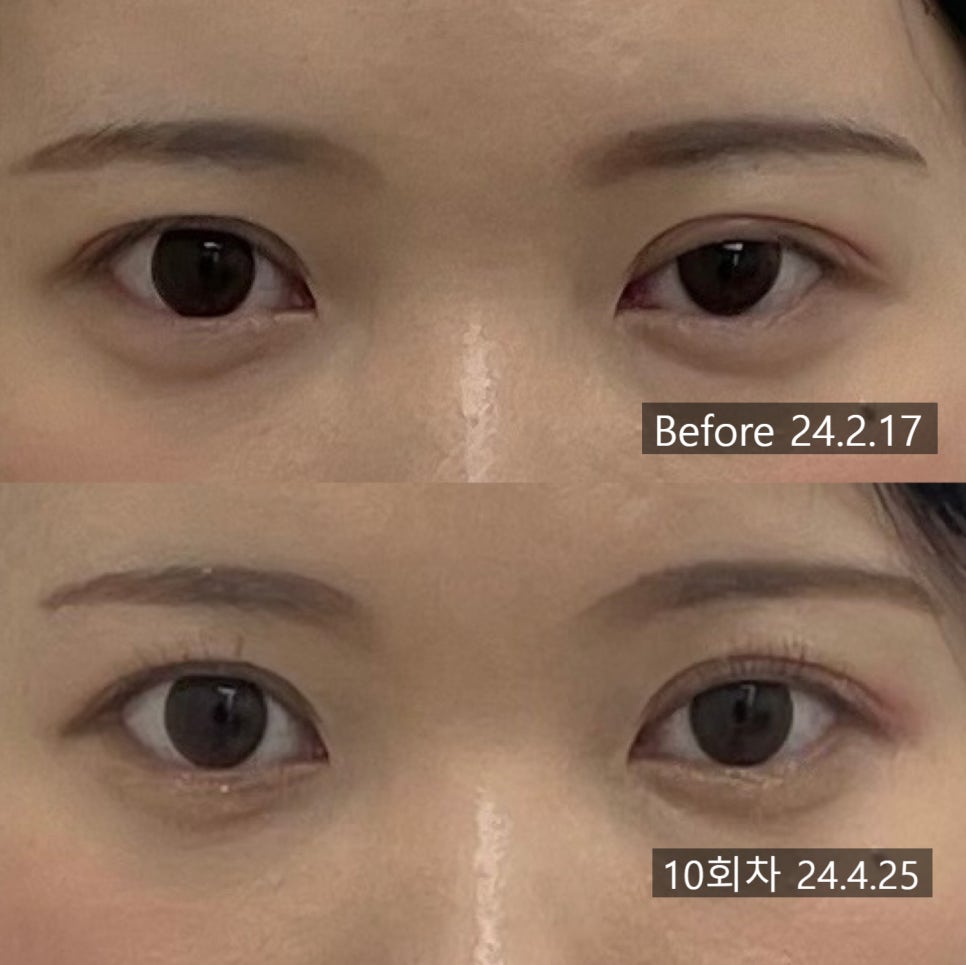 눈매교정 시술 기록 3 — 동일 인물·동일 조건에서 촬영한 보정 없는 원본 사진