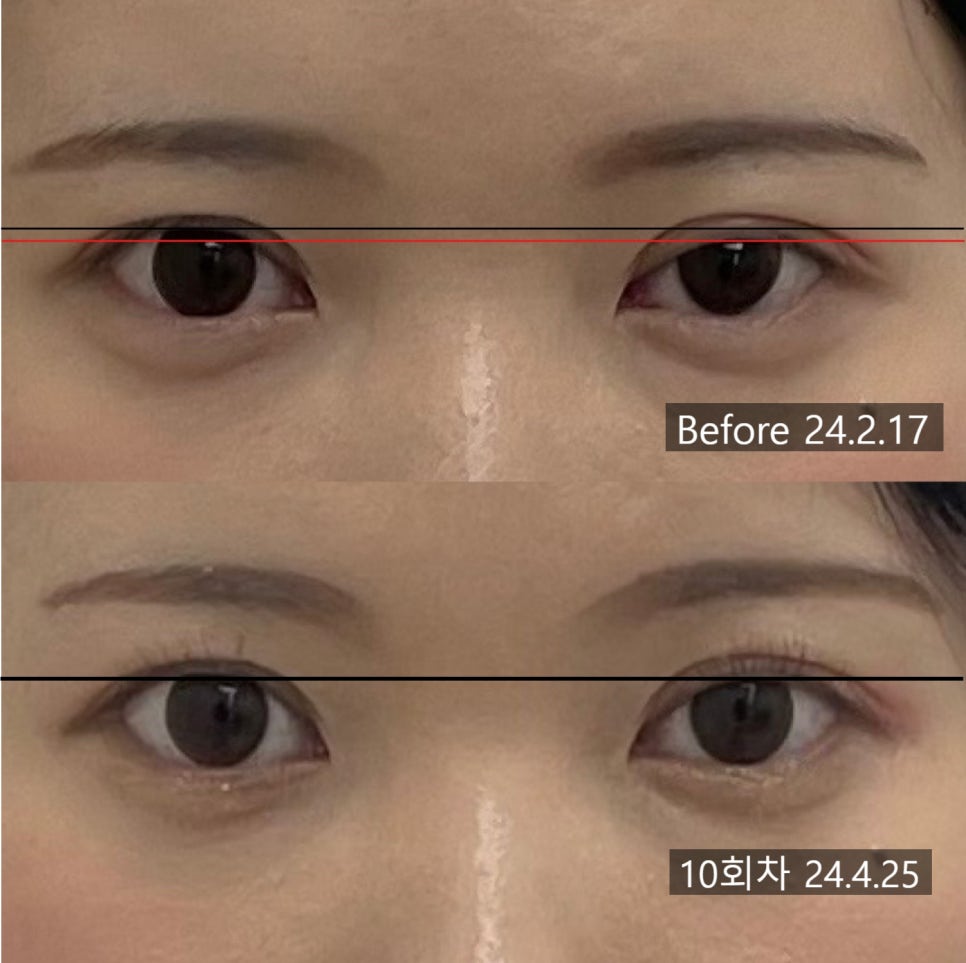 눈매교정 시술 기록 4 — 동일 인물·동일 조건에서 촬영한 보정 없는 원본 사진