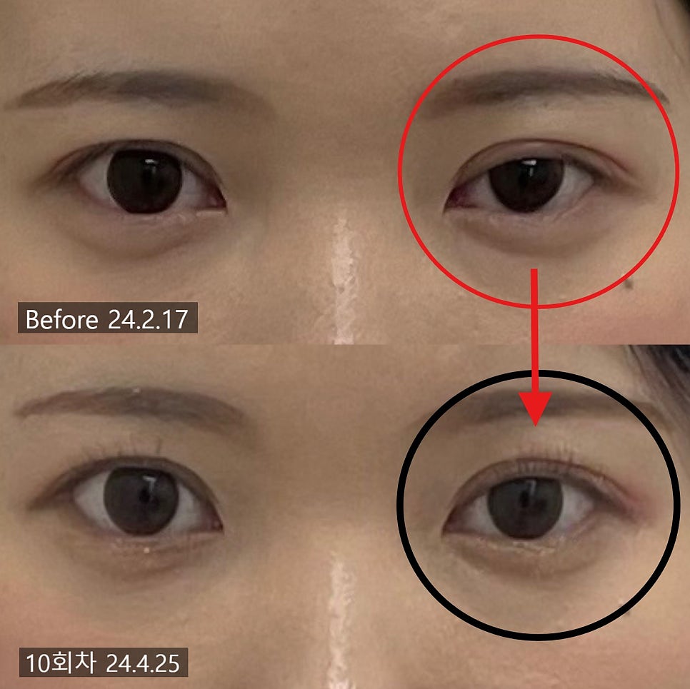 눈매교정 시술 기록 6 — 동일 인물·동일 조건에서 촬영한 보정 없는 원본 사진