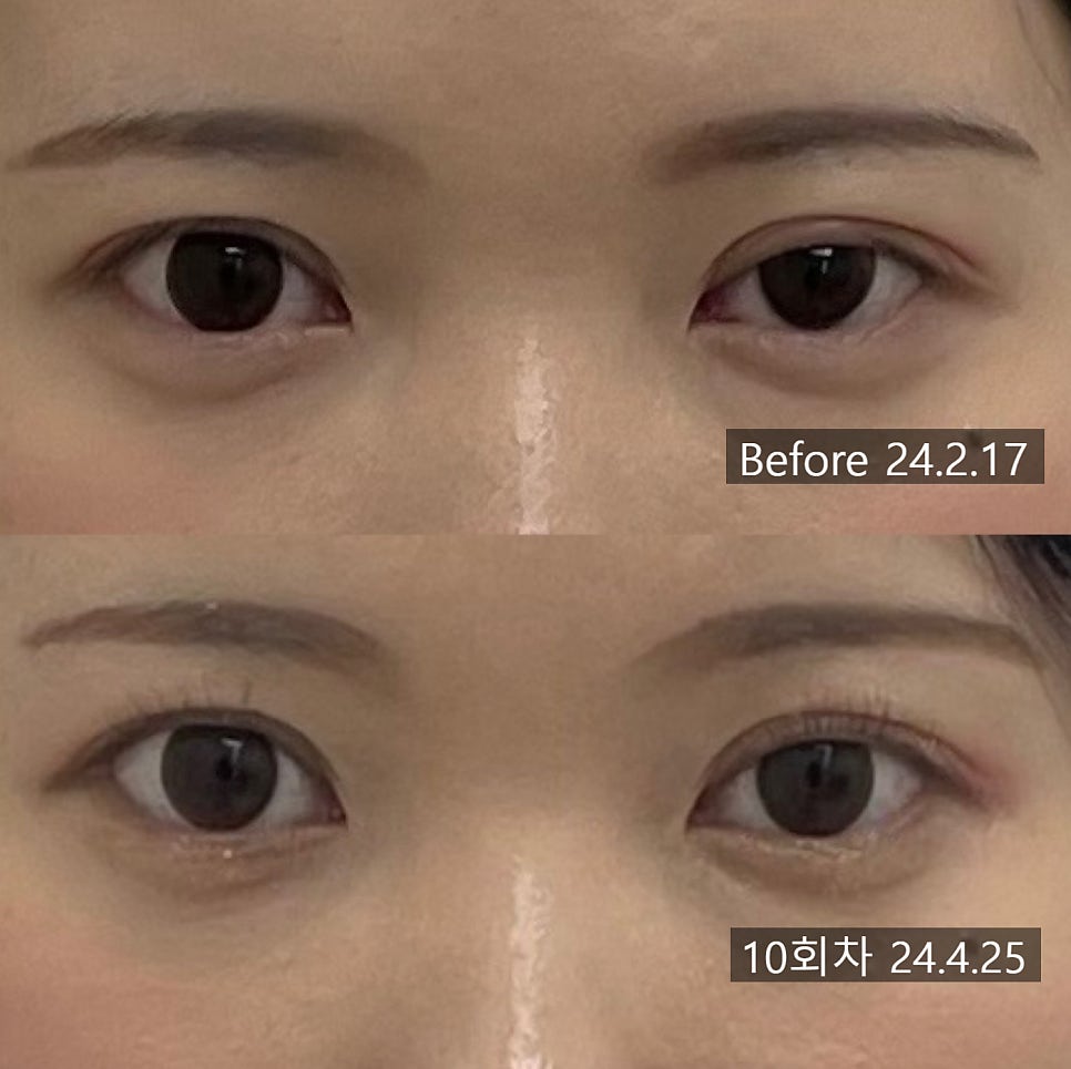 눈매교정 시술 기록 7 — 동일 인물·동일 조건에서 촬영한 보정 없는 원본 사진