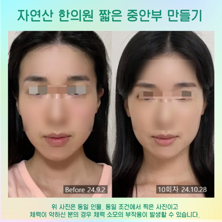 younger-looking-face 치료 사례 1 — 시술 전후 비교