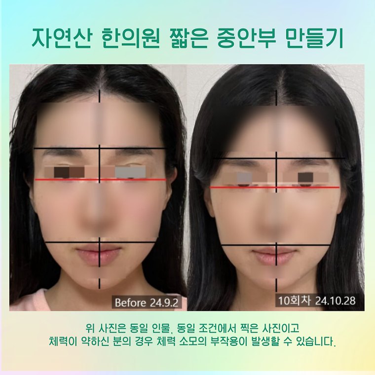 younger-looking-face 치료 사례 2 — 시술 전후 비교