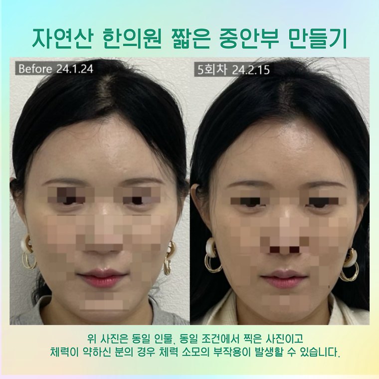 younger-looking-face 치료 사례 3 — 시술 전후 비교