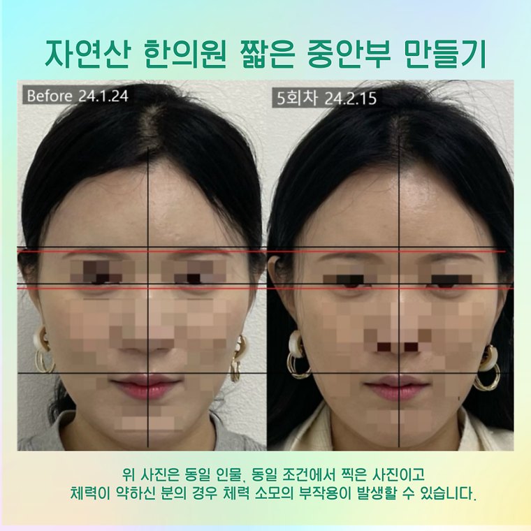 younger-looking-face 치료 사례 4 — 시술 전후 비교