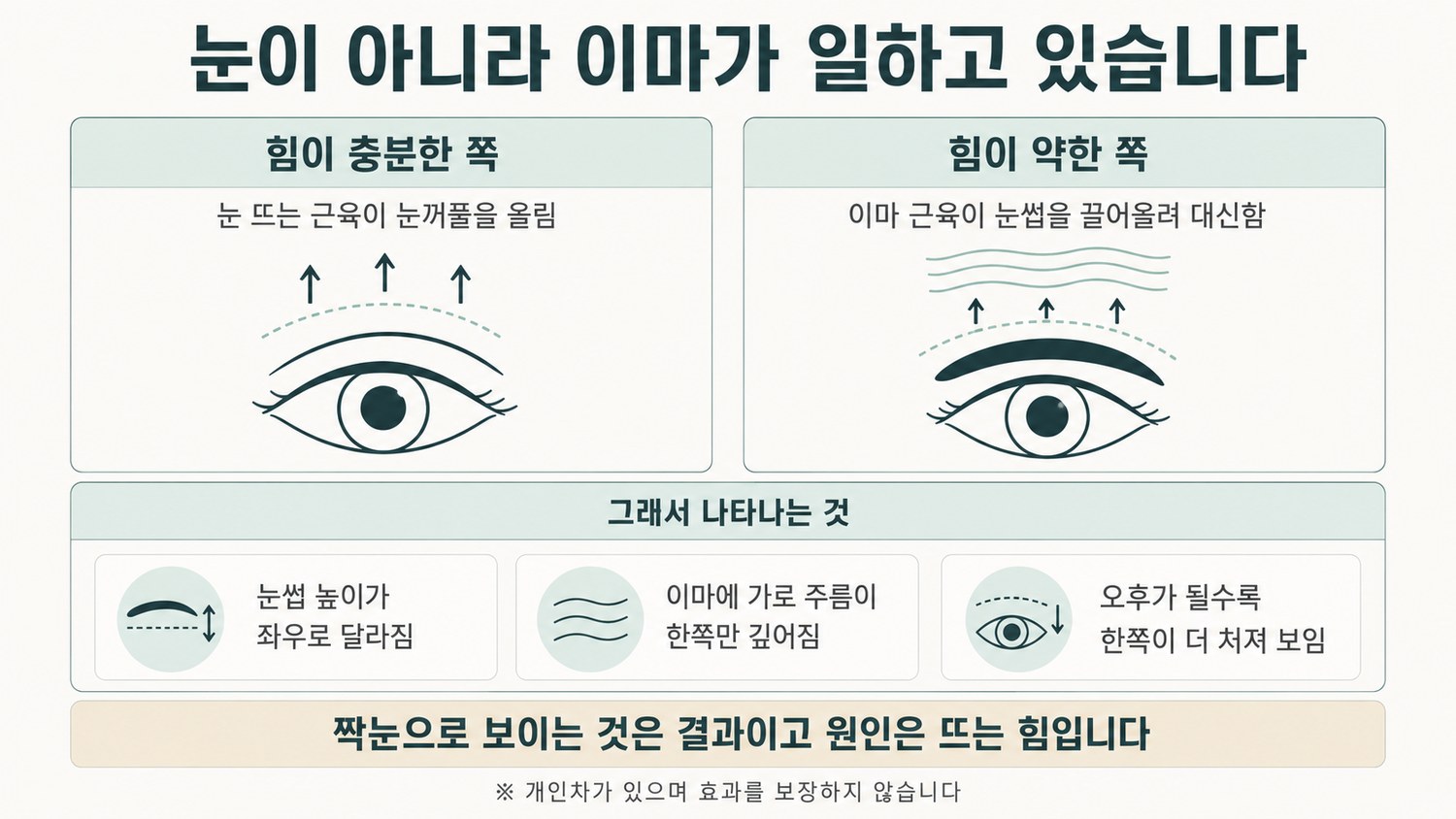 눈 뜨는 힘이 약한 쪽에서 이마 근육이 눈썹을 대신 들어 올리며 좌우 눈썹 높이가 달라지는 보상 구조를 단계별로 표시한 도해
