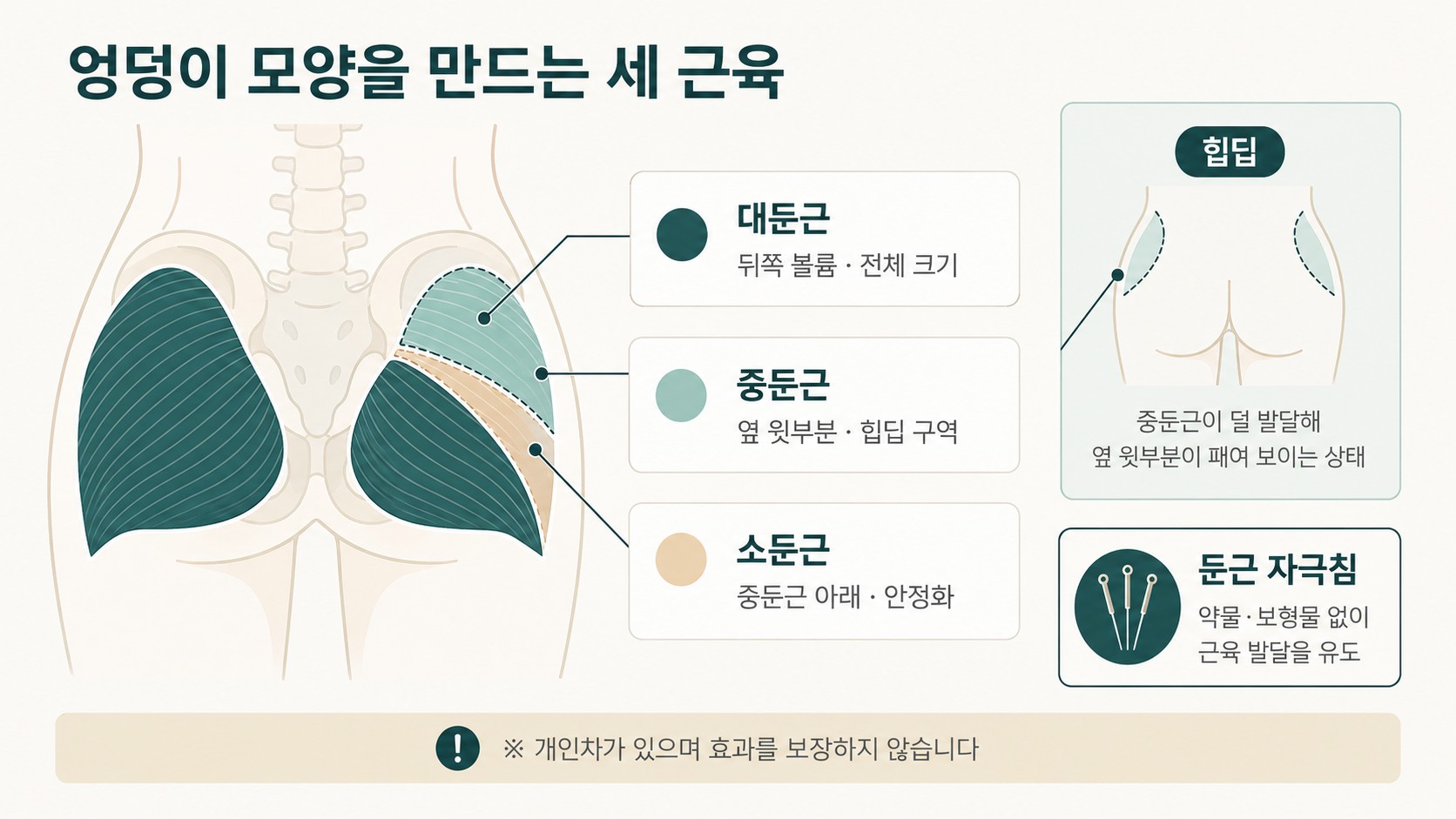 대둔근·중둔근·소둔근의 위치와 각각이 담당하는 엉덩이 형태 구역, 힙딥 구역을 표시한 해부 도해