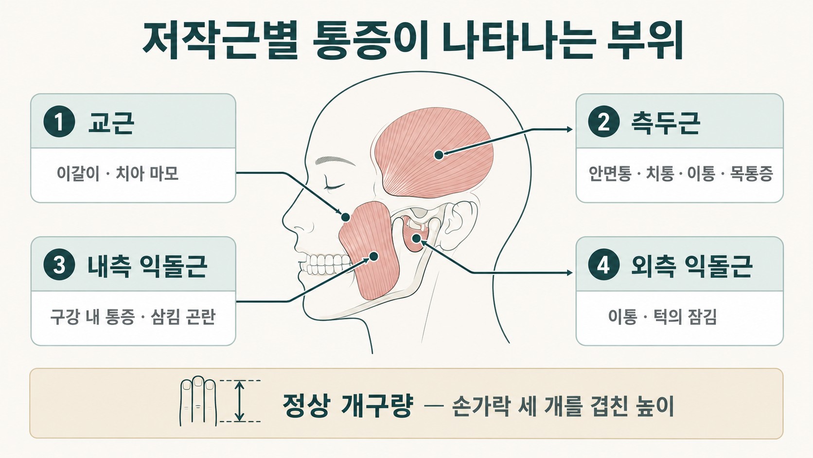 교근·측두근·내측익돌근·외측익돌근의 위치와 각각의 연관통 부위를 화살표로 연결한 해부 도해