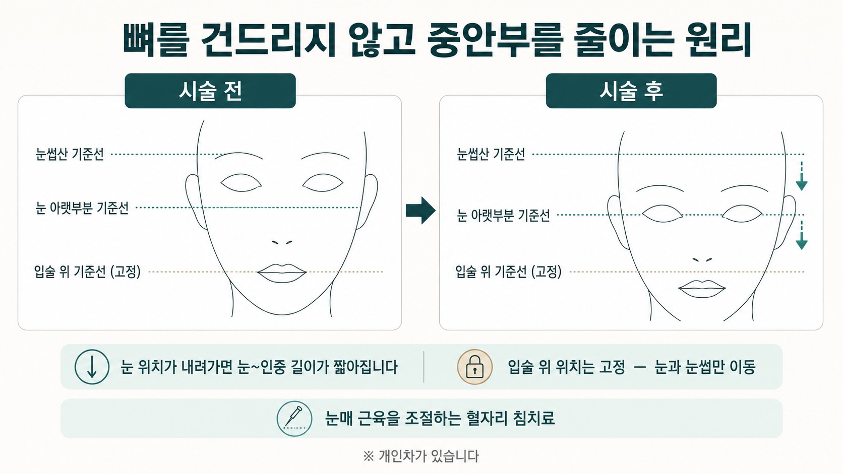 시술 전후 기준선 세 개로 눈 위치가 내려가 눈~인중 길이가 짧아지는 원리를 대비한 도해