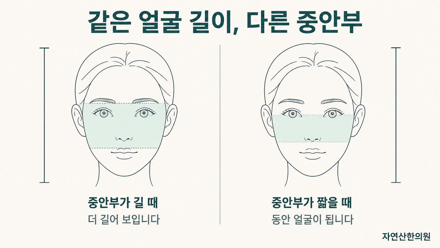 얼굴 전체 길이는 같고 중안부 길이만 다른 두 얼굴을 나란히 놓아 인상 차이를 비교한 도해