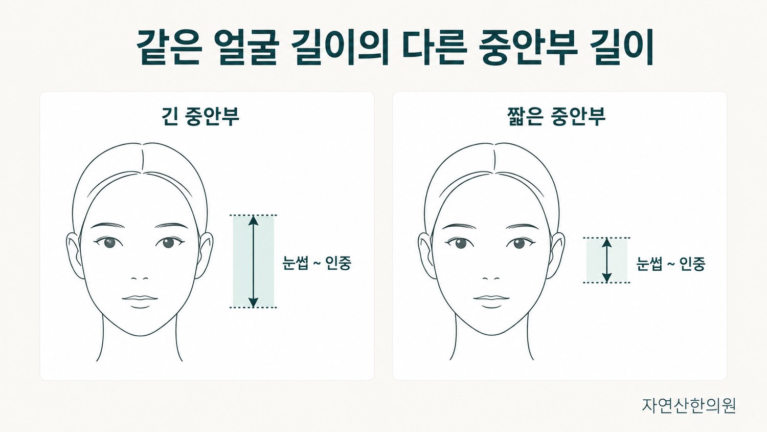 같은 얼굴 길이에서 중안부 길이만 다르게 표시한 두 얼굴을 나란히 놓은 비교 도해